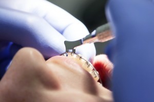 Beugel / Orthodontie