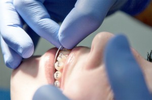 Beugel / Orthodontie
