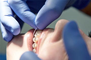 beugel orthodontie